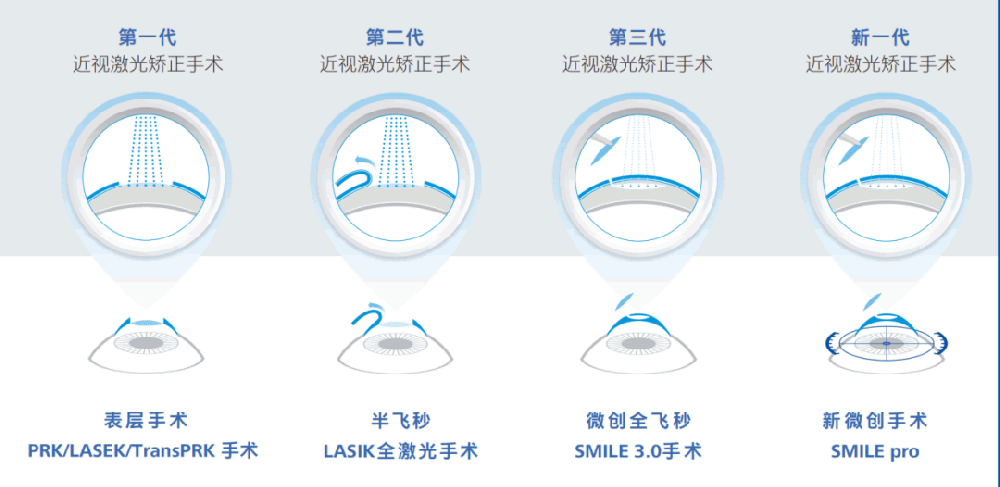 一文读懂 | 新一代全飞秒 SMILE pro